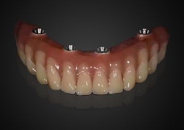 satın al Kişiselleştirilmiş Dental İmplant Taçları Uzun süreli kullanım için giyim dayanıklı Çevrimiçi üretim