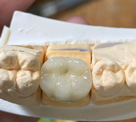 satın al Dental PFM porselenin metal taçla füzelenmesi Çevrimiçi üretim