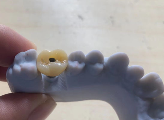 Yüksek hassasiyetli implant destekli taç
