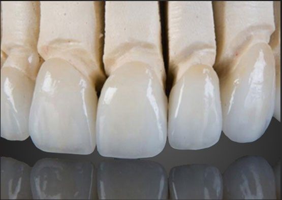 Wieland Zirconia Tüm Keramik Taç İç Resim CAD Tasarımı ile Özel
