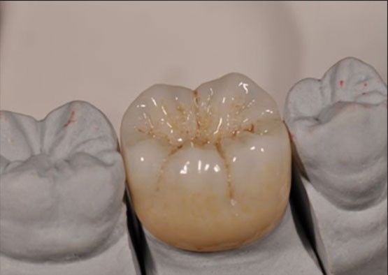 Yüksek Estetik Noritake Zirkonya Doğal Renk Tam Zirkonya Tacı için Sabit