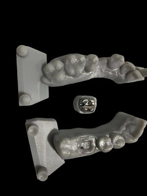 Dental Restorasyon için korozyona dayanıklı metal direk ve çekirdek yüksek yapışkanlık