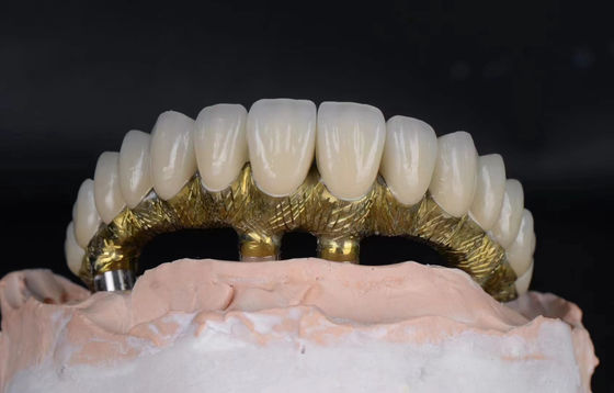 Titanyum alaşımlı diş implantları ve taçları doğal görünümlü korozyona dayanıklı