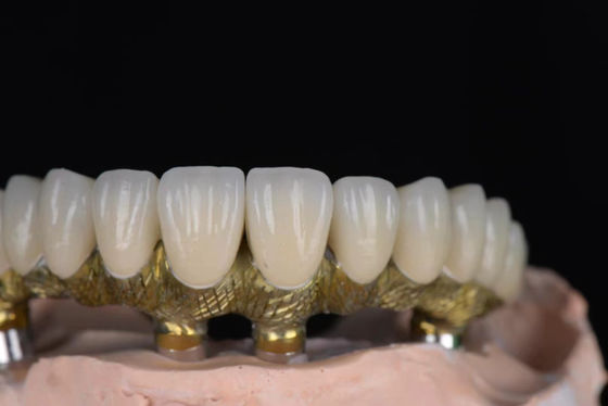 Doğal Görünümlü Taç Porselen, Diş İmplantları İçin Yüksek Hassasiyetle Metalle Erimiş