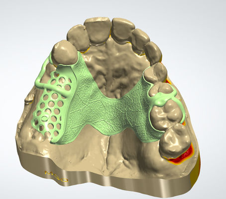 Dijital Metal Çerçeve CAD CAM Diş Tasarımı Cocr Malzemesi 3D Baskı ile