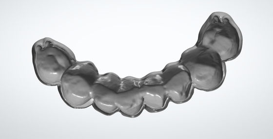 PMMA Geçici Köprü İmplantı için CAD CAM Diş Tasarımı
