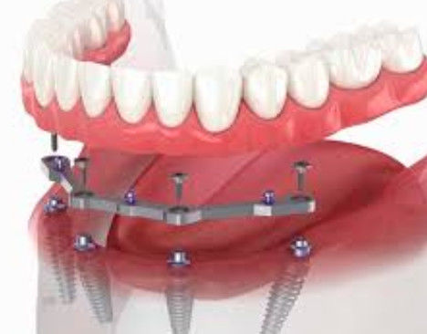 Tam kemerli Titanyum Bar Dental 12mm Uzunluk 2+ Eklemlerle